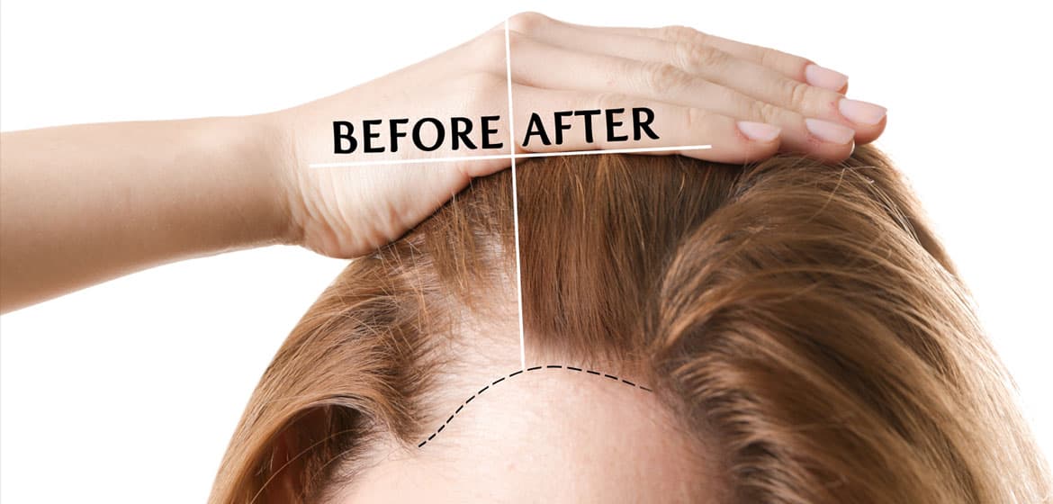 Hair Transplantation for Women